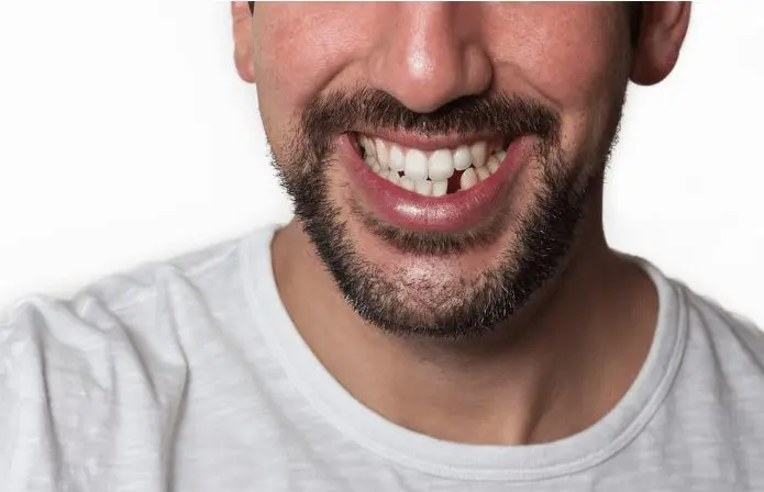 missing teeth