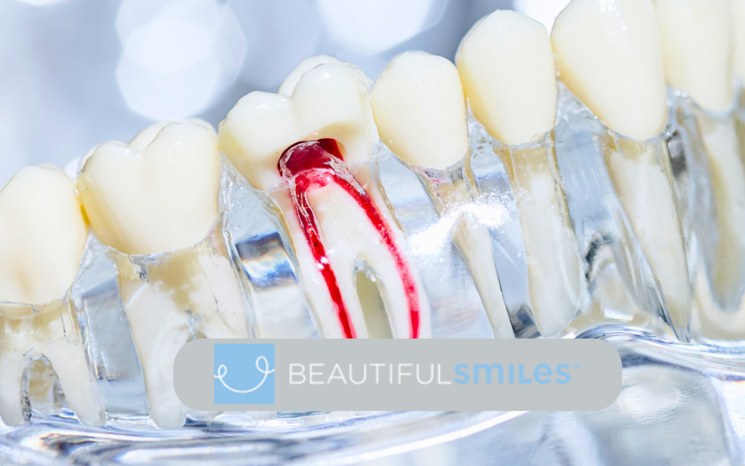 5 Excellent Benefits of Root Canal Treatment You Should Know