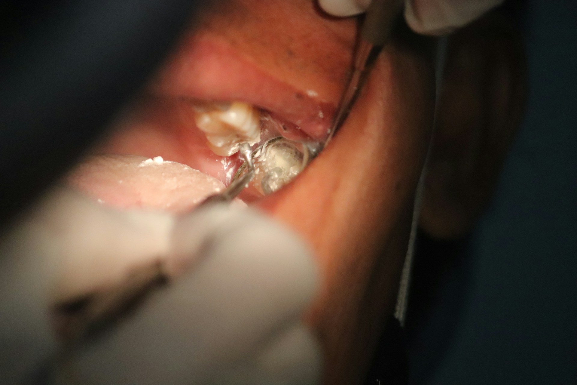 Is It a Cavity or Something Worse?