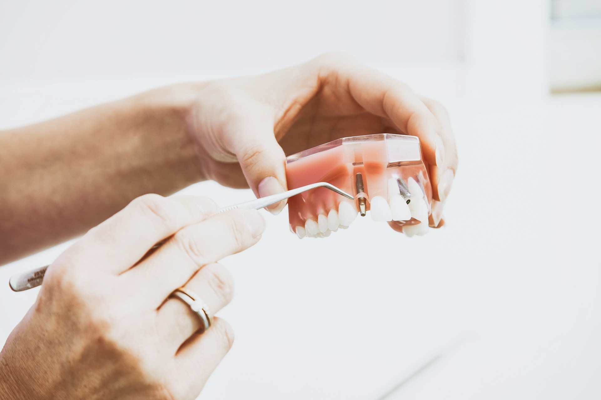 How Dental Implants Work in Greenwood