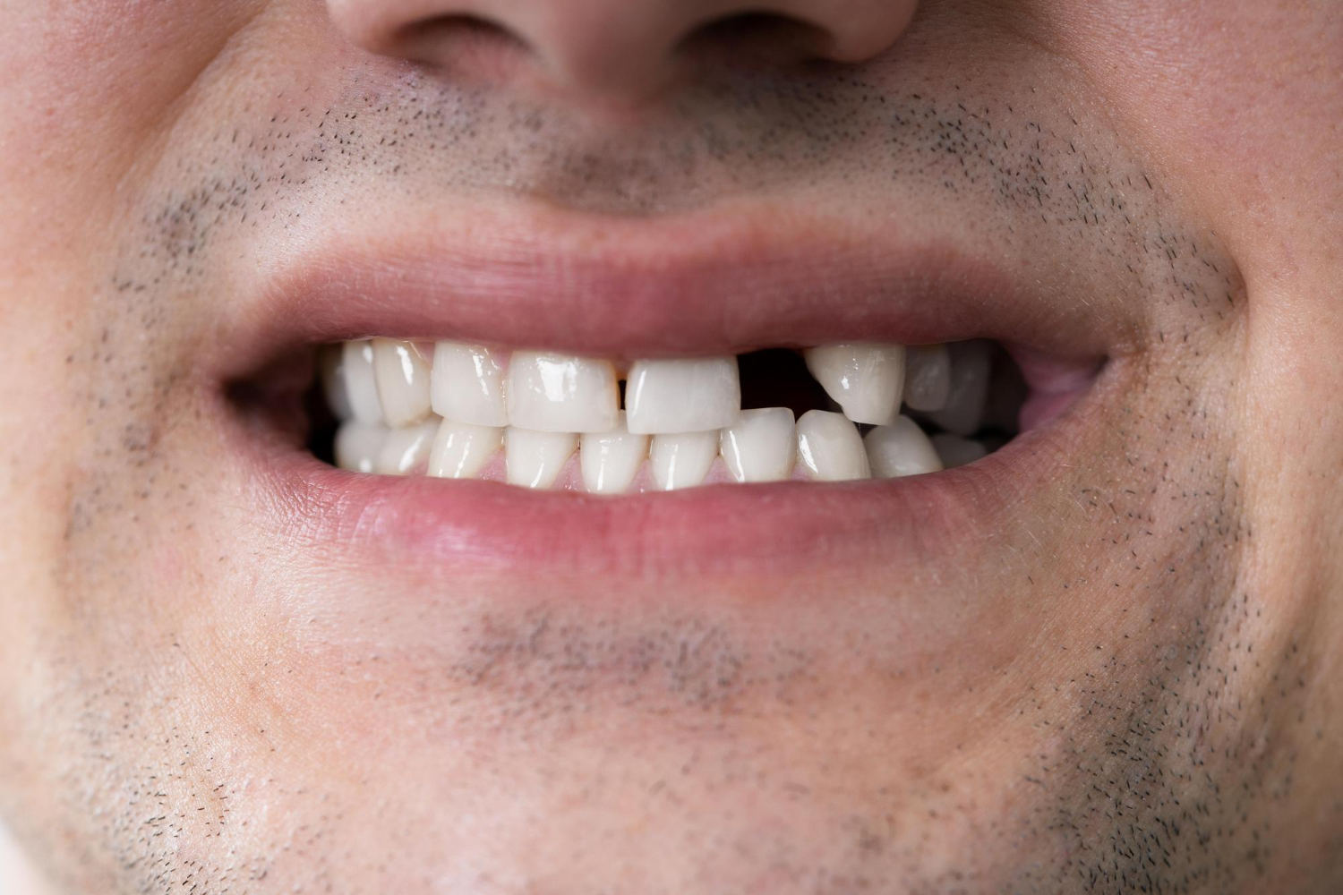 Why You Shouldn’t Ignore a Missing Tooth