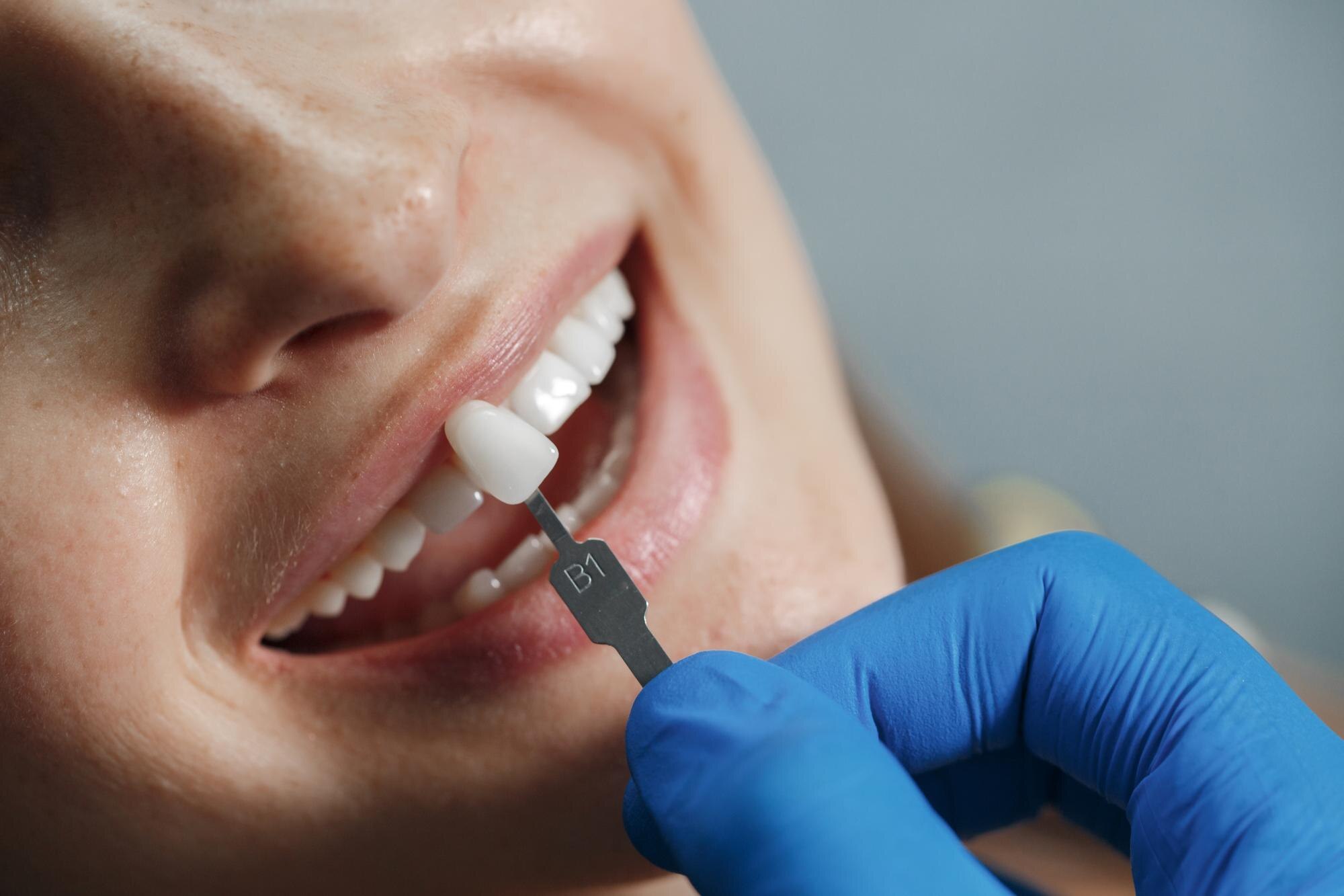 When a Dental Crown Is the Best Way to Save a Tooth