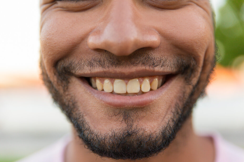 discolored teeth
