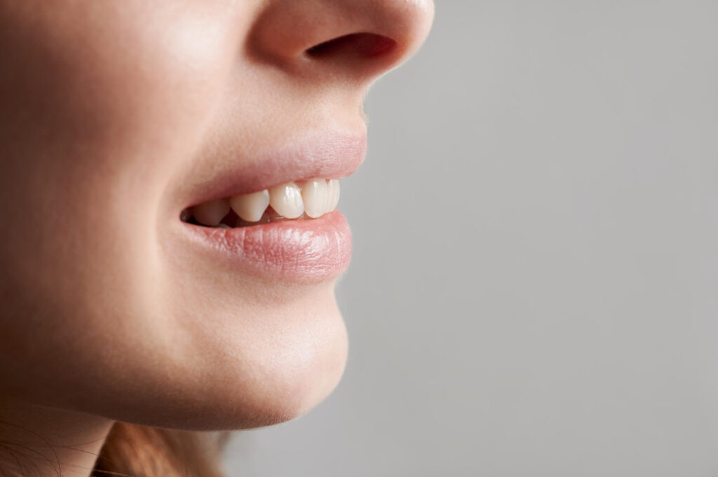crooked teeth