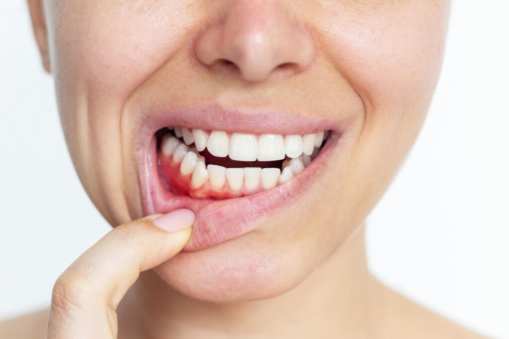 bleeding gums