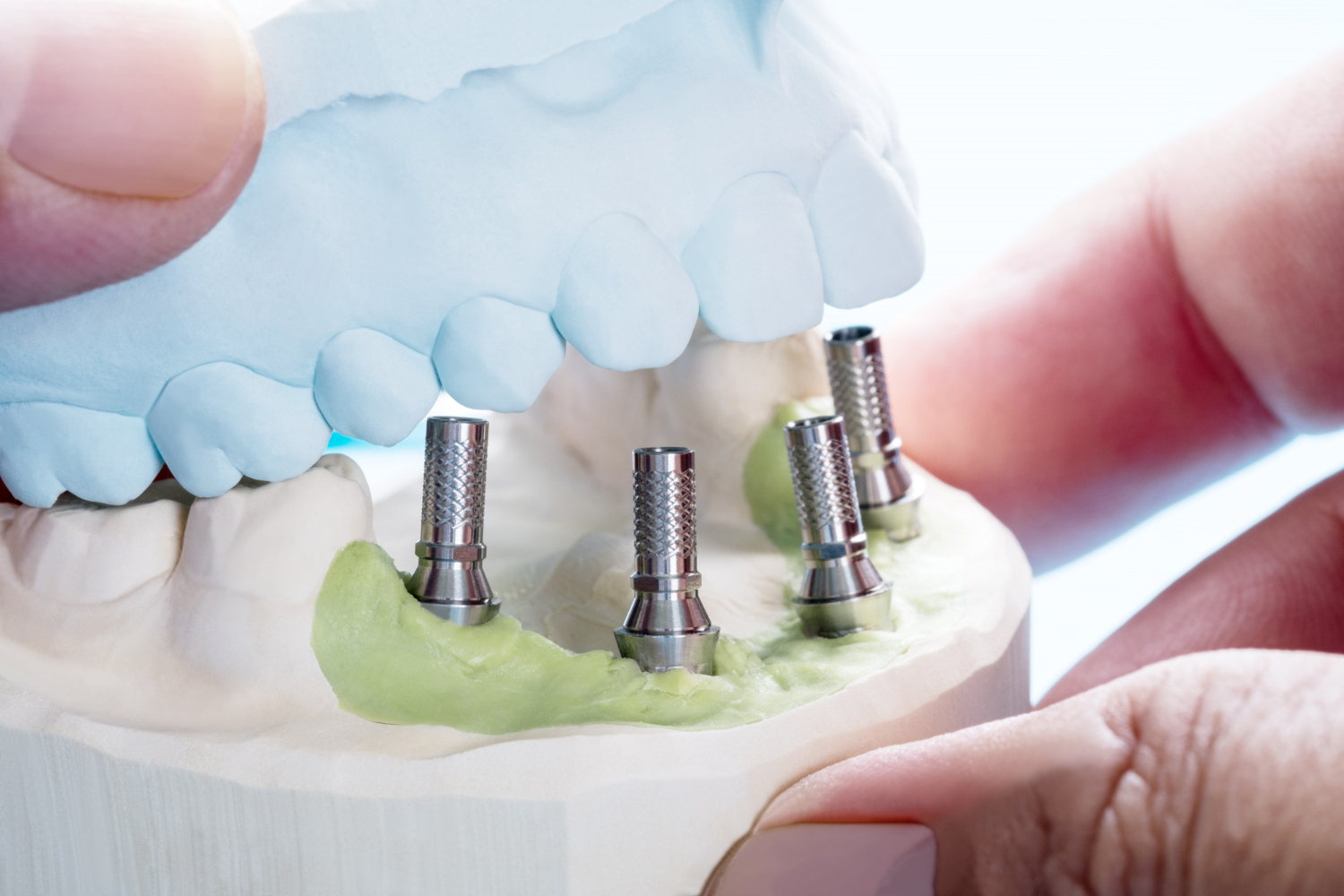 Dental Implants Explained: A Long-Term Solution for Missing Teeth