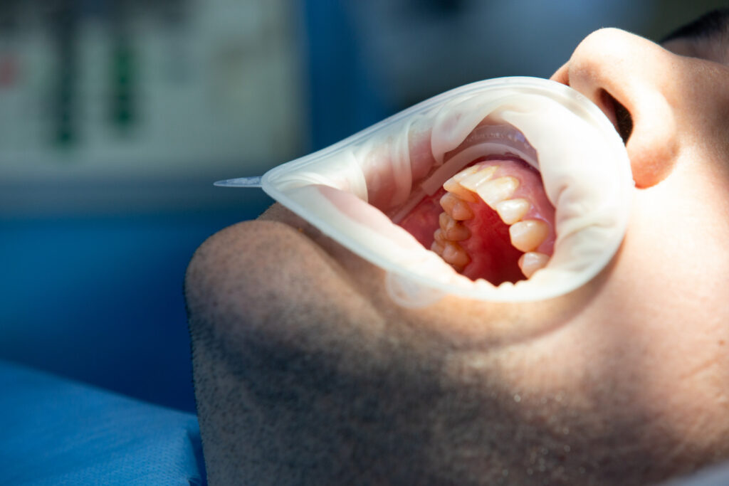 severe pulp infection