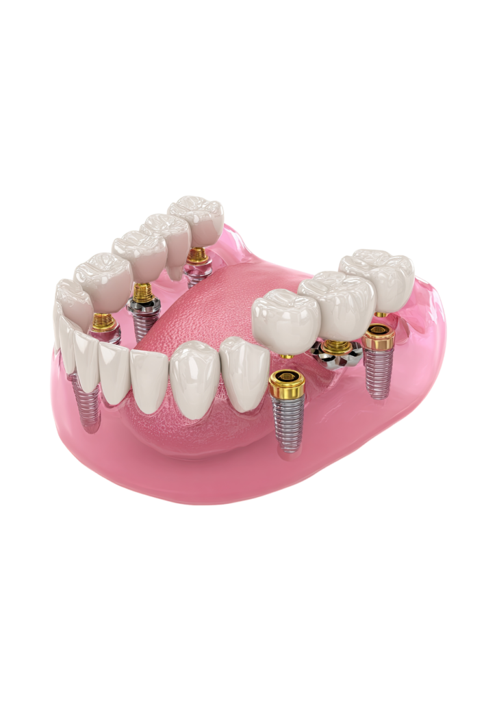 picture of implant supported dentures