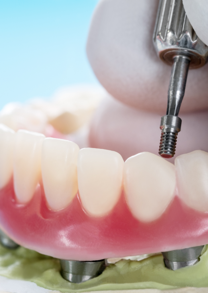 Example of implant supported bridges