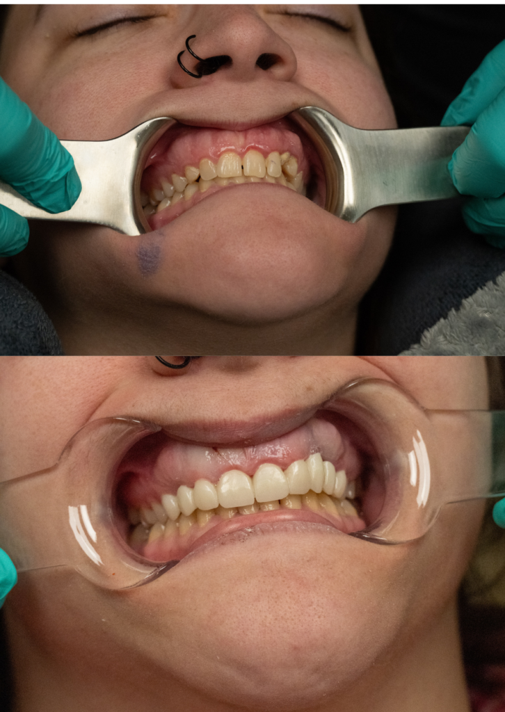 before and after of a full arch restoration