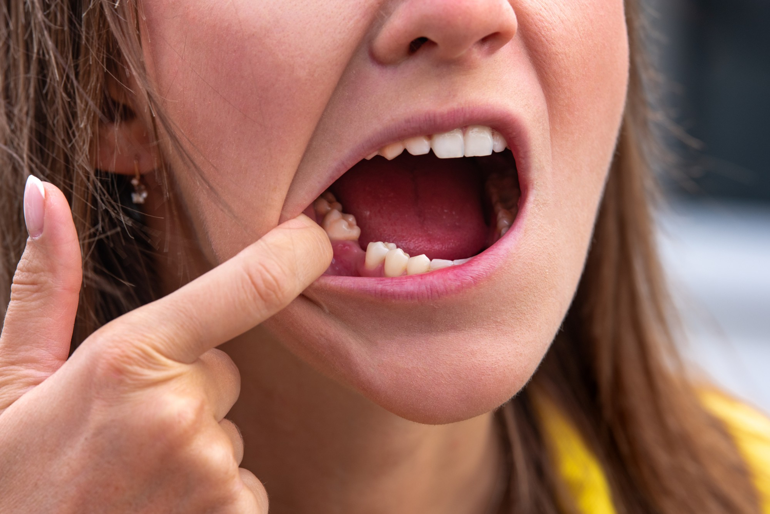 How Missing Teeth Can Make You Look and Feel Older